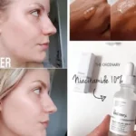 لایه برداری ملایم و کاهش تیرگی و لک های پوستی