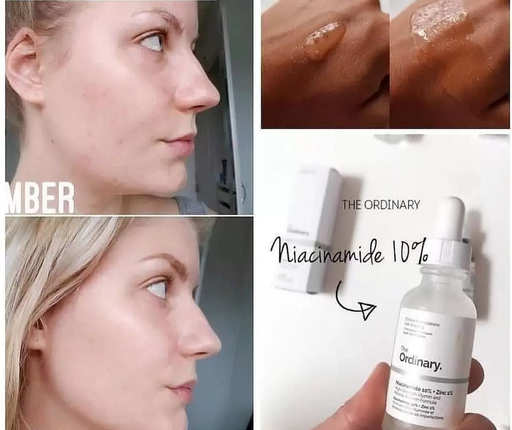 لایه برداری ملایم و کاهش تیرگی و لک های پوستی