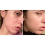 سرم ضد لک نیاسینامید 10% + ترانگزامیک 4% آنوا